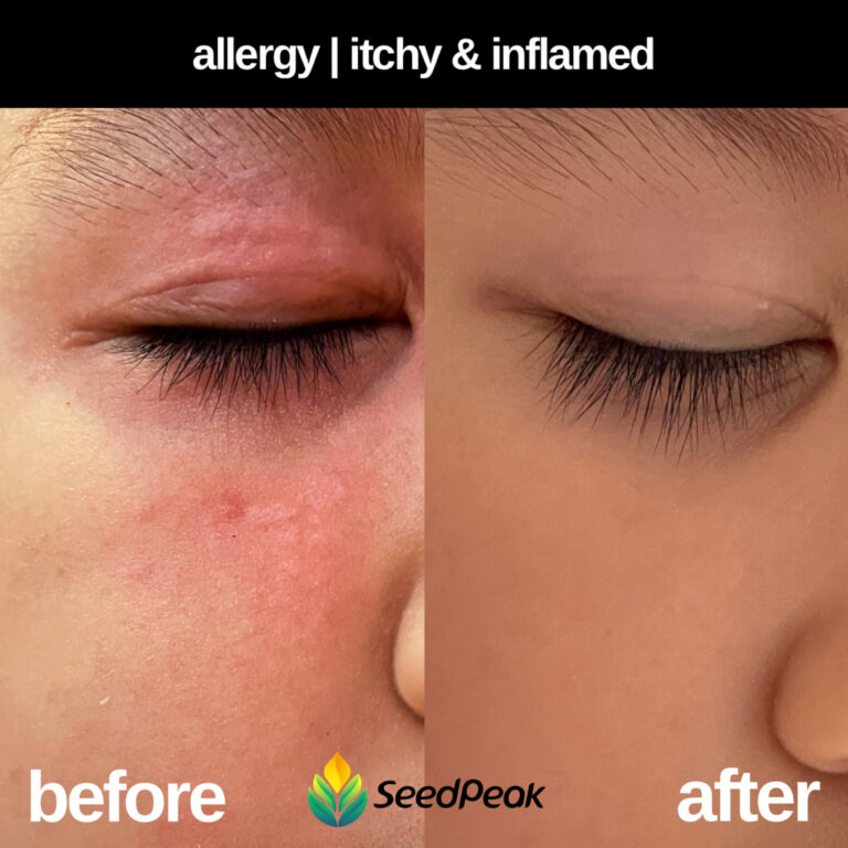 Allergy+Itchy+Inflamed (1)