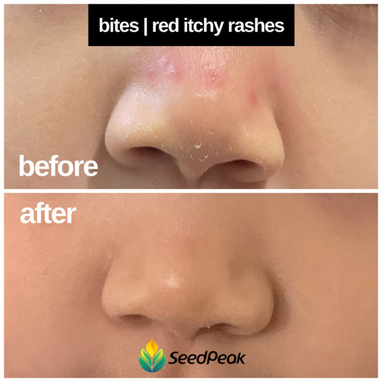 Bites+Itchy
