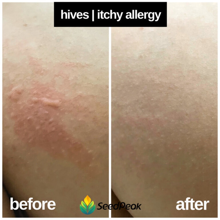 Hives