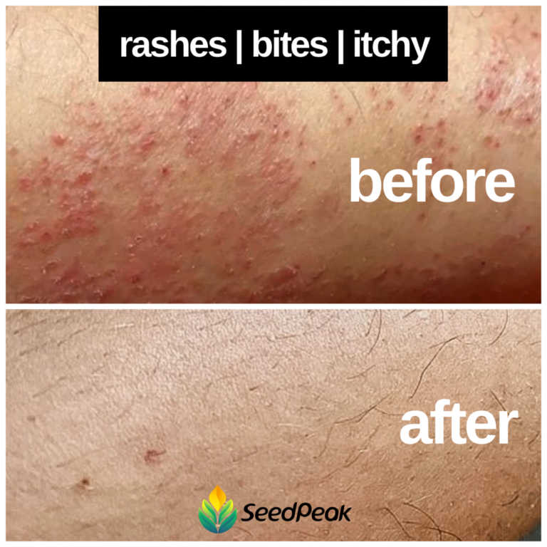 Rashes+Bites+Itchy